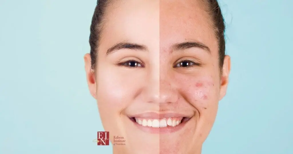 Using Holistic Nutrition For Acne | Online Nutrition Training Course & Diplomas | Edison Institute of Nutrition is a Nutrition School