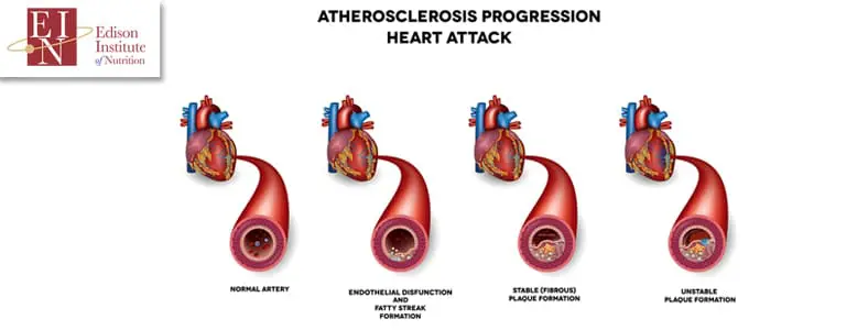 heart disease, its symptoms, and its causes | Online Nutrition Training Course & Diplomas | Edison Institute of Nutrition