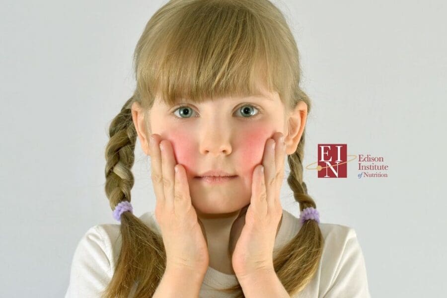 Using Registered Holistic Nutrition as Treatment for Eczema | Online Nutrition Training Course & Diplomas | Edison Institute of Nutrition is a Nutrition School Training Nutrition Professionals Worldwide