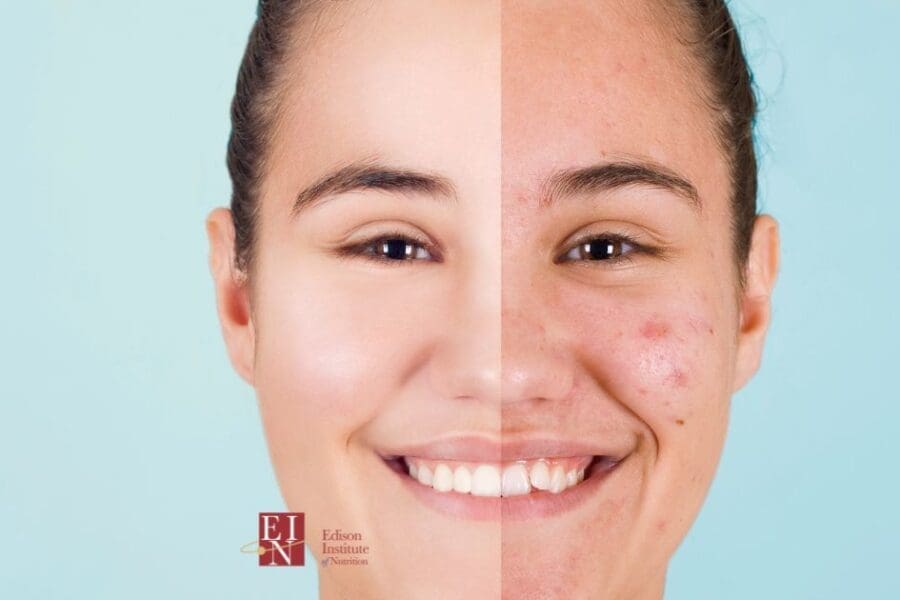 Using Holistic Nutrition For Acne | Online Nutrition Training Course & Diplomas | Edison Institute of Nutrition is a Nutrition School